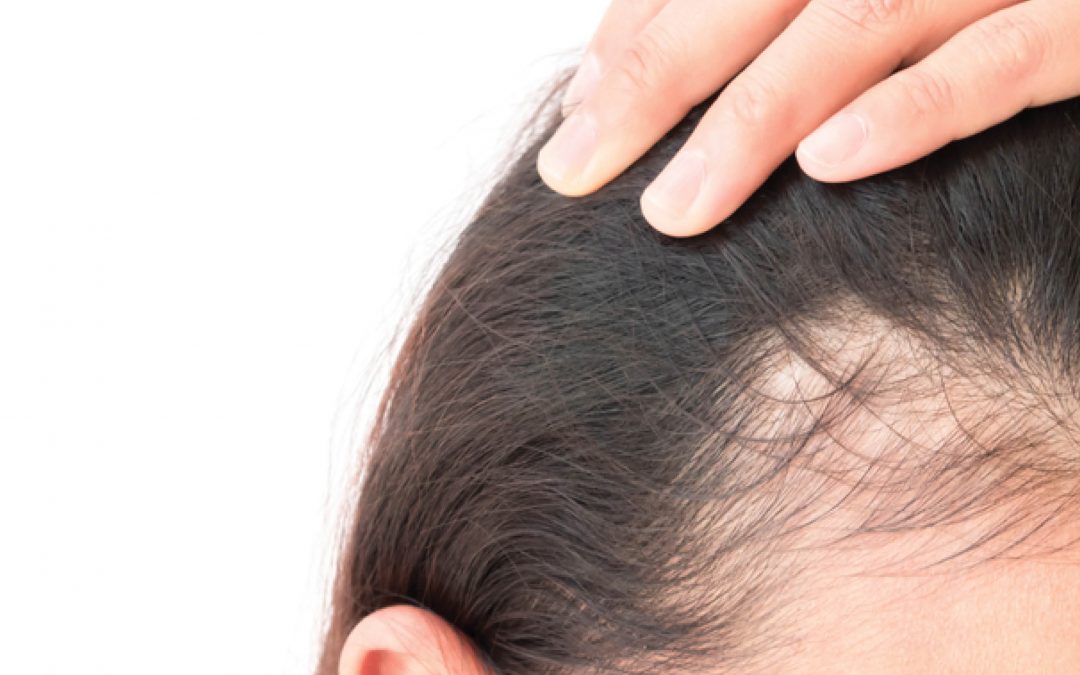 Conheça os melhores tratamentos para alopecia