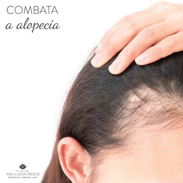 Conheça os melhores tratamentos para alopecia