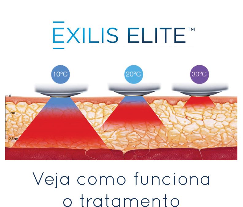 Exilis Elite: tratando flacidez e pequenas gorduras
