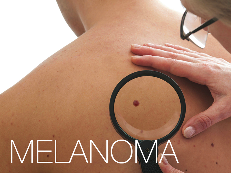 Saiba mais sobre o melanoma